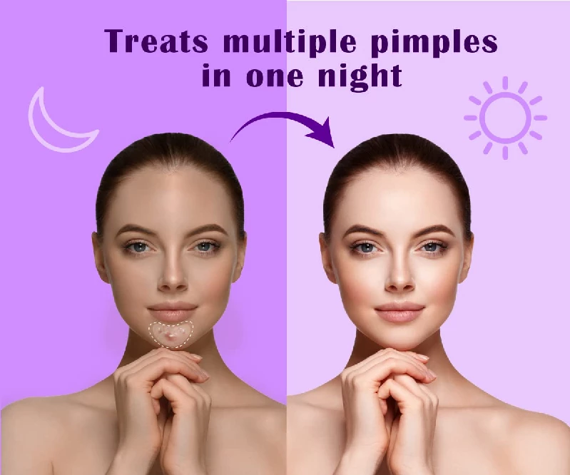 Urban Yog Acne Pimple Patch-Invisible Facial Stickers, Curvy Pimple Patch-2.webp